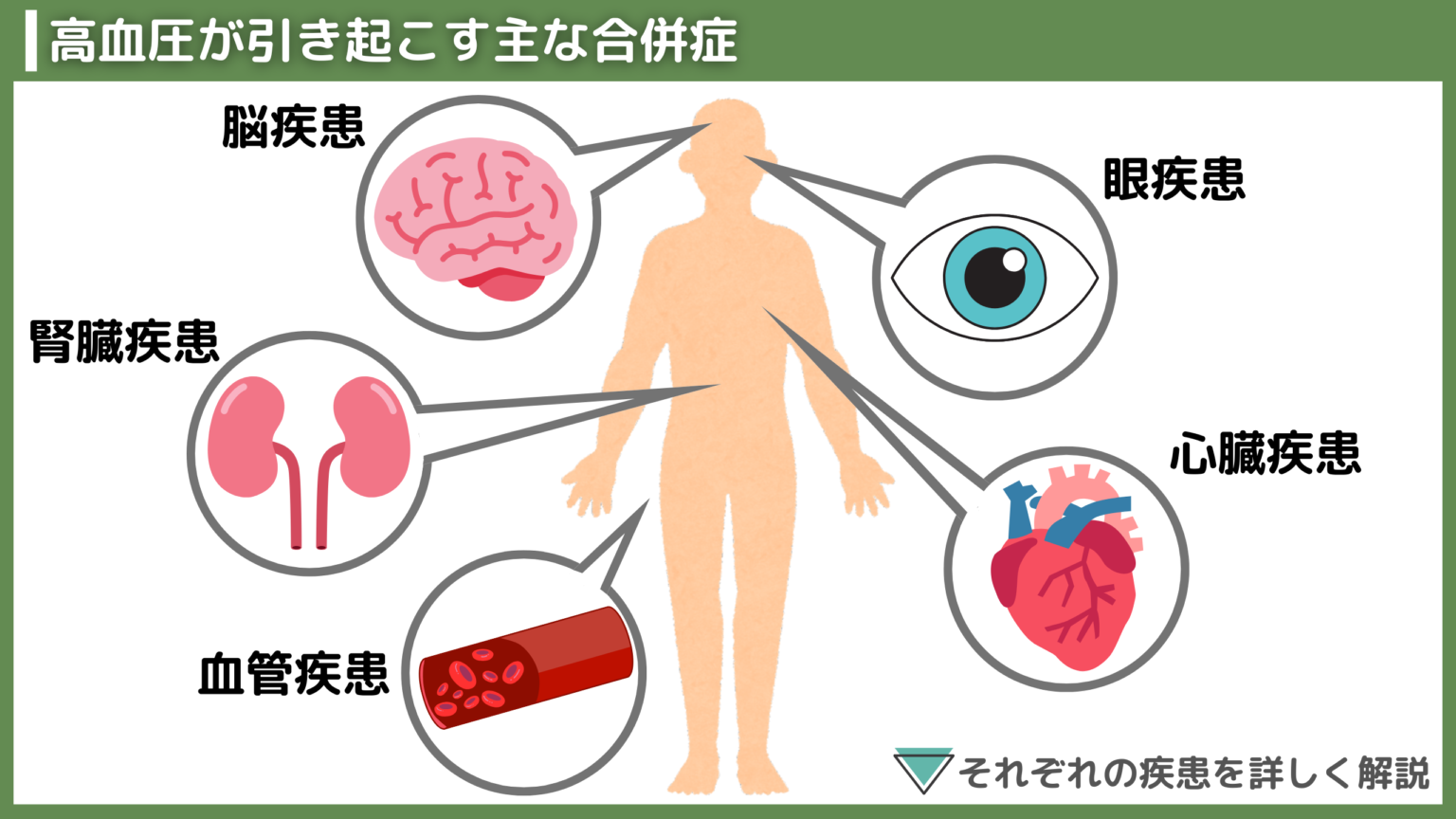高血圧がもたらす危険性|血圧が高いと出る症状から合併症まで紹介|生活習慣病のオンライン診療ならヤックル